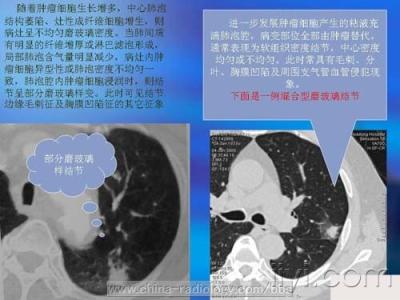 周围型肺癌鉴别诊断 周围型肺癌鉴别诊断方法