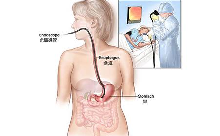 女性胃癌的早期症状 女性胃癌的早期症状有哪些