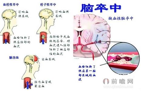 中风偏瘫康复的技巧 让男人远离中风的技巧