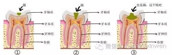 支气管结核的六大症状 牙齿六大症状暗藏隐患