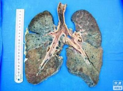 尘肺病的治疗方法 尘肺病怎么治疗_尘肺病的治疗方法