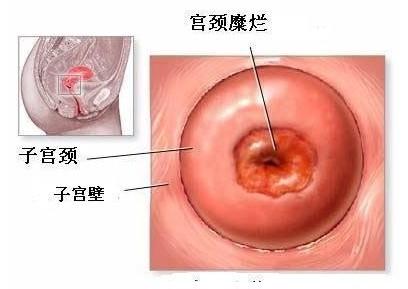 宫颈成熟度如何检查 孕妇宫颈成熟需要多久 怎样检查宫颈成熟度