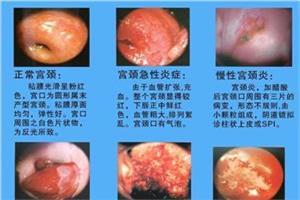 宫颈癌病因 什么是宫颈癌 宫颈癌病因 宫颈癌治疗