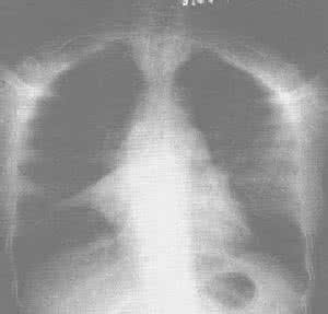 新生儿肺不张 新生儿肺不张是什么