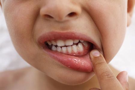 小孩虫牙牙疼快速止疼 虫牙疼怎么办_如何有效预防虫牙
