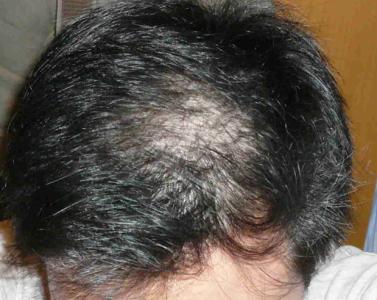 常见的男性脱发的原因 生活常见脱发原因