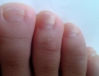 轻微灰指甲的症状图片 灰指甲的早期症状