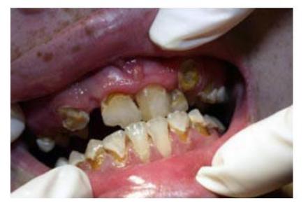 冰毒腐蚀牙齿的症状 冰毒对牙齿的危害