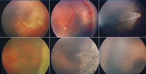 早产儿视网膜病变 早产儿视网膜病变是什么