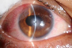 角膜炎是红眼病吗 角膜炎是什么