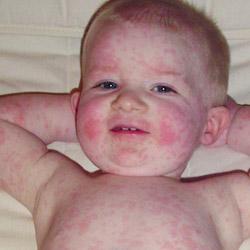 婴儿急疹不能吃什么 婴儿急疹是什么