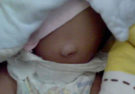 新生儿脐疝初期的图片 新生儿脐疝怎么办