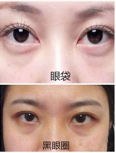黑眼圈和眼袋辨别图 眼袋和黑眼圈的区别