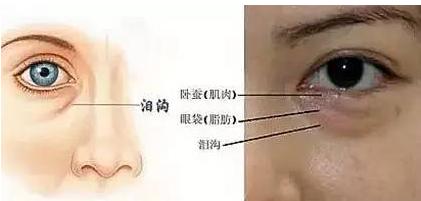 黑眼圈和眼袋的区别 眼袋和黑眼圈的具体区别