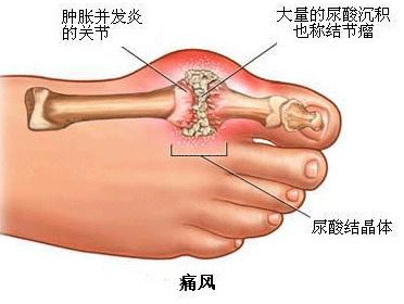 脚痛风的治疗方法 痛风症状