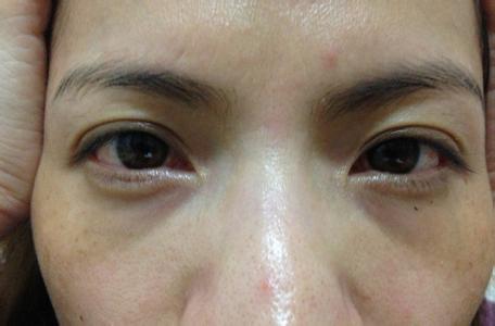 如何改善黑眼圈和眼袋 如何有效改善黑眼袋
