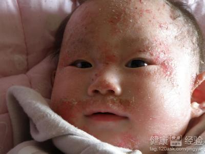 婴儿湿疹最佳治疗方法 婴儿湿疹的四大原因及治疗方法