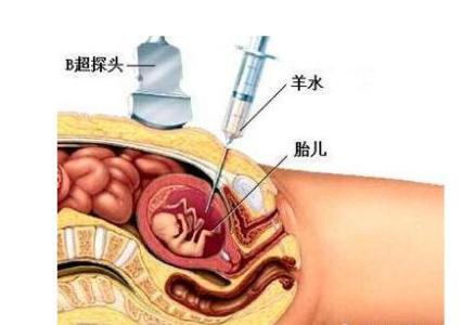 妈妈在家羊水破了视频 羊水早破如何在家处理