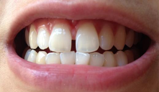 牙齿疾病有哪些种类 牙齿疾病的种类有哪些