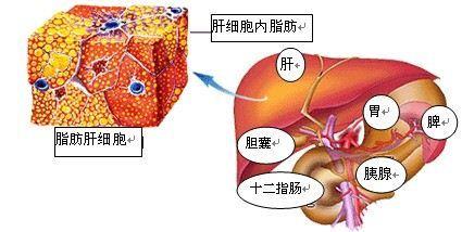 脂肪堆积 脂肪堆在哪儿更伤身