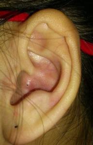 耳朵上长硬块怎么回事 耳朵长硬包怎么回事