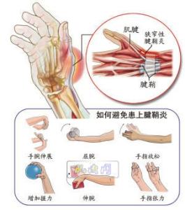 预防腱鞘炎 腱鞘炎6种方法可预防