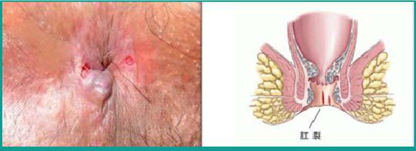 肛周脓肿预防 怎么预防猪肛肿病