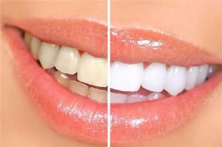 牙齿发黄是什么原因 牙齿发黄是什么原因呢