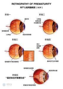 新生儿视网膜病变治疗 早产儿视网膜病变治疗