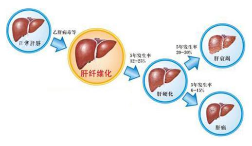 治疗肝纤维化好方法 什么是肝纤维化 肝纤维化病因 肝纤维化治疗