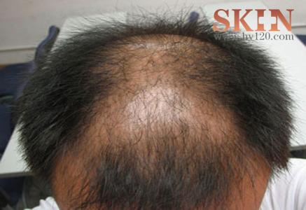 脂溢性脱发的食疗 脂溢性脱发的食疗_脂溢性脱发的症状