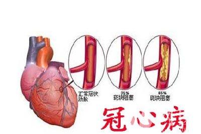 冠心病的治疗方法 什么是冠心病 冠心病治疗方法