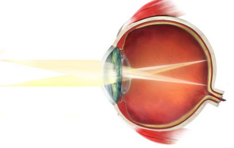早产儿视网膜病变 如何预防早产儿视网膜病变