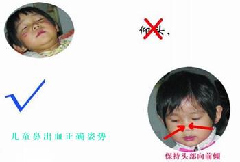 儿童鼻出血 如何防止儿童鼻出血？