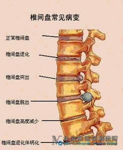 腰椎间盘突出早期症状 腰椎间盘突的出早期症状