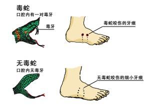 无毒蛇咬伤 毒蛇养殖过程的咬伤急救处理