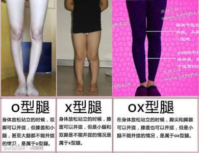 如何判断x型腿 什么是x型腿