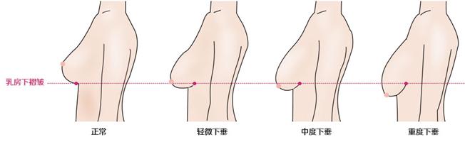 乳房下垂如何整形 乳房下垂要如何保养