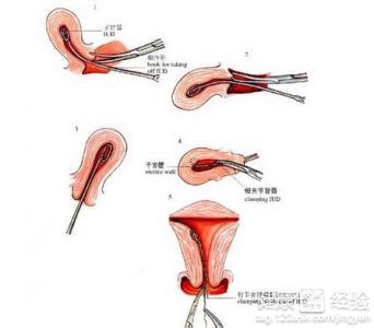 上环后出血多注意 上环后出血怎么办