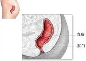 如何区分内痔和直肠癌 如何区分痔疮和直肠癌