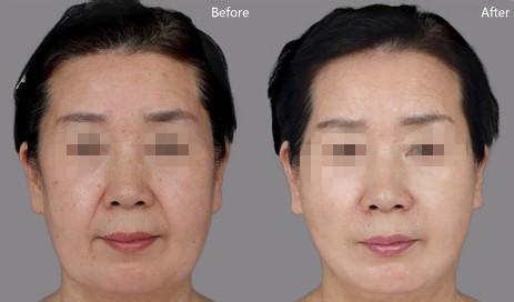 脸部皮肤松弛下垂偏方 防止脸部下垂松弛有什么方法