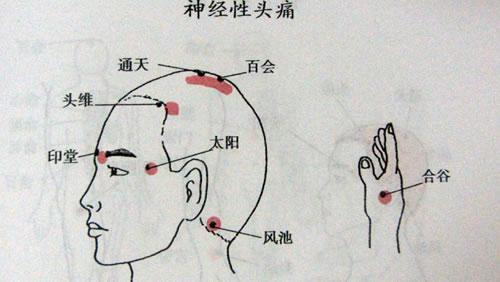 神经性偏头痛的原因 神经性偏头痛的原因是什么