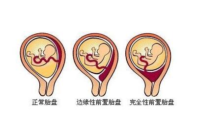 什么是中央性前置胎盘 什么导致中央性前置胎盘