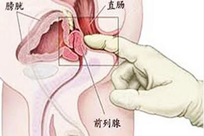 前列腺炎按摩什么穴位 按摩什么穴位能治前列腺炎