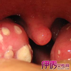 喉咙发炎吃什么药好 喉咙发炎吃什么(2)
