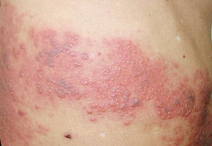 夏季皮肤病预防 皮肤病如何预防？夏季易发的皮肤病