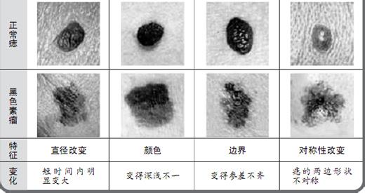 黑色素瘤早期症状图片 黑色素瘤和痣的区别