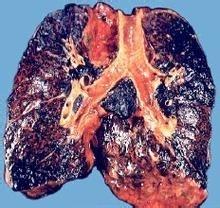 长期抽烟的肺部图片 长期抽烟的危害