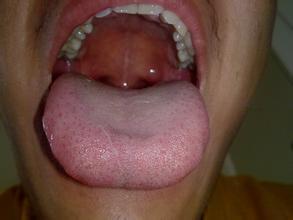 舌苔厚黄怎么食疗方法 舌苔厚黄的原因和食疗