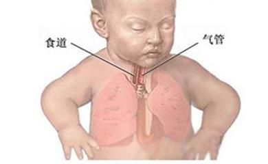 新生儿肺炎的护理要点 新生儿肺炎的特点